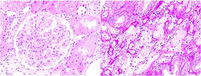 Frontiers Case Report A Case Report Of Alport Syndrome Caused By A Novel Mutation Of Col A